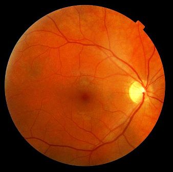 Human eye. The light circle is where the optic nerve exits the retina.